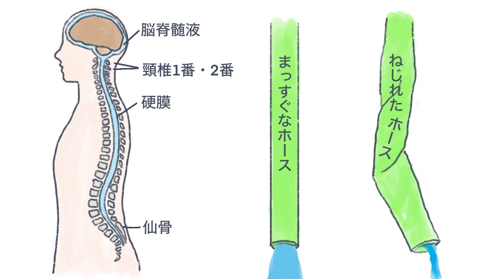 脳脊髄液の流れが悪くなる原因